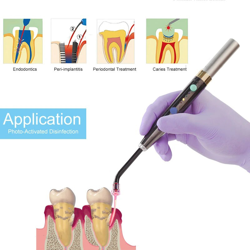 Sistema Láser Dental Inalámbri - Diode Laser Module reseña y precio